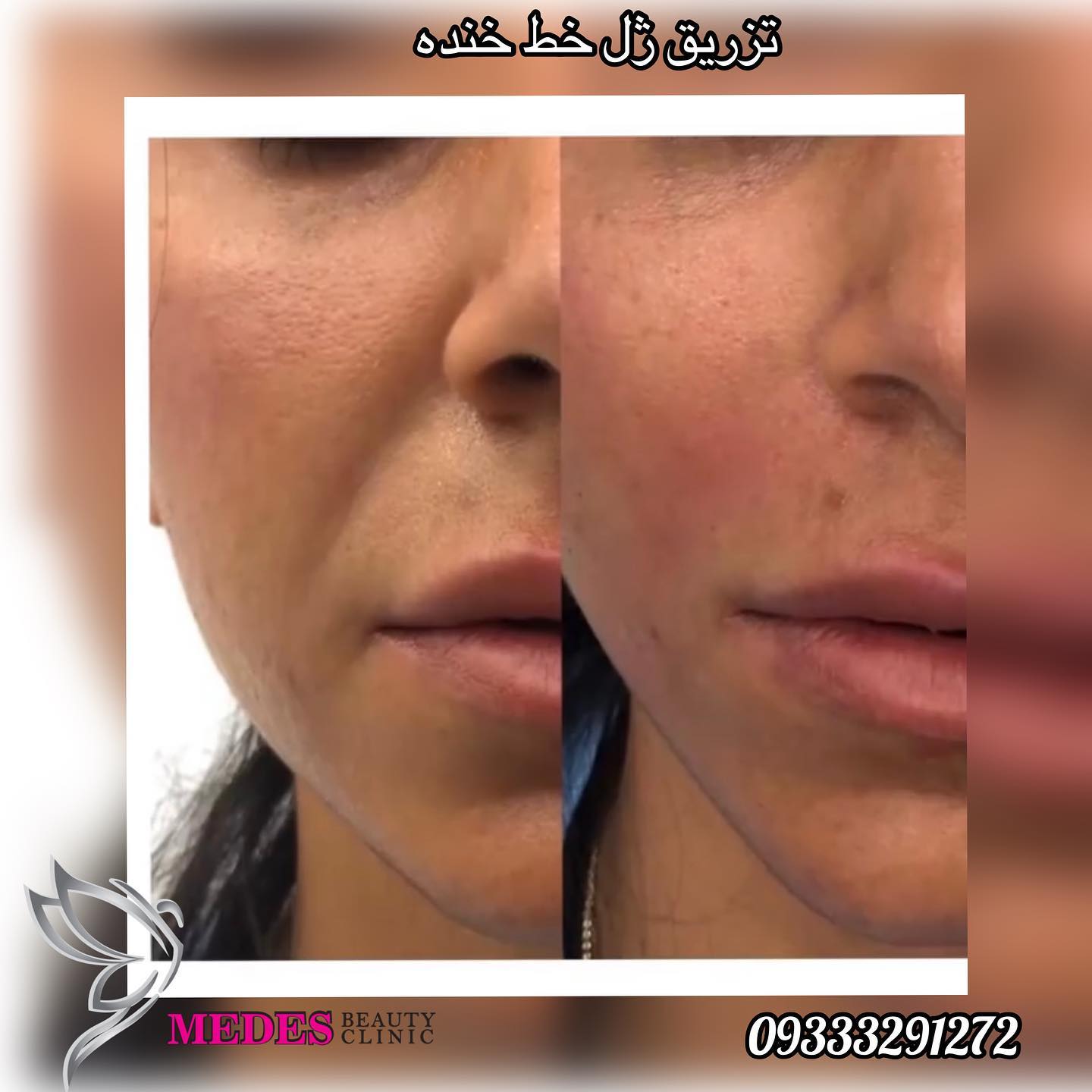 گالری زاویه سازی صورت